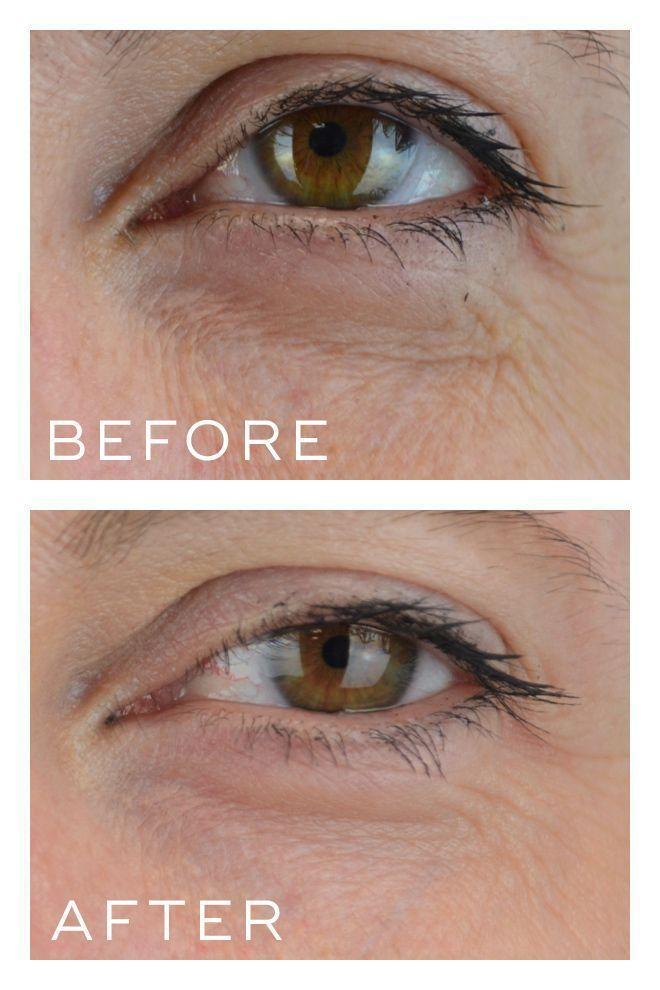 Medik8 Crystal Retinal 1, before and after