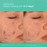 Dermalogica Breakout Biotic Moisturiser