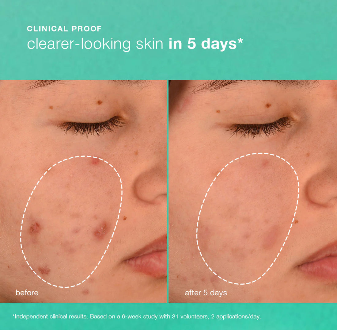 Dermalogica Breakout Biotic Moisturiser